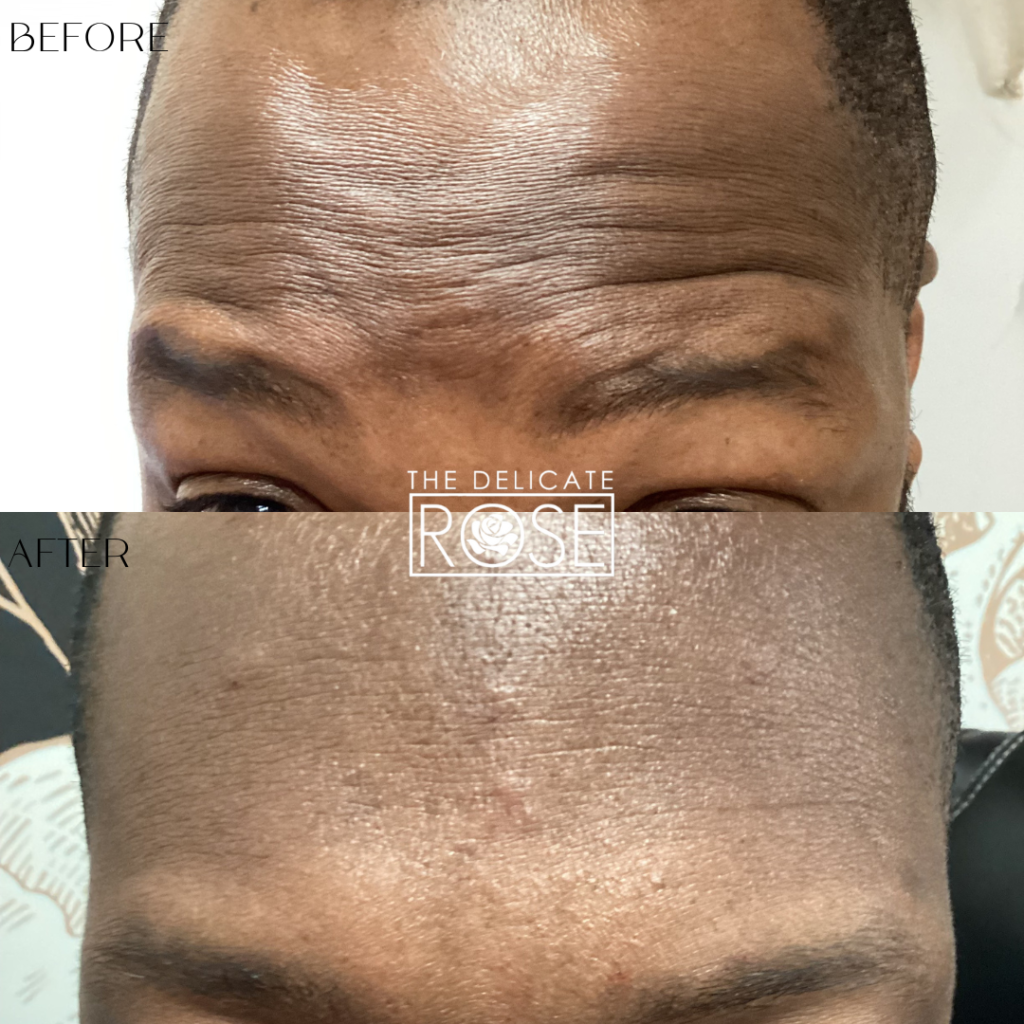 Before & After (Botox & Fillers) 1