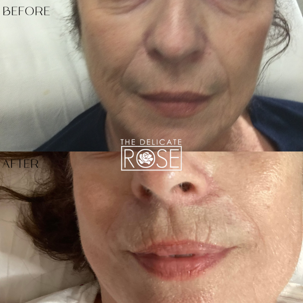 Before & After (Botox & Fillers) 10