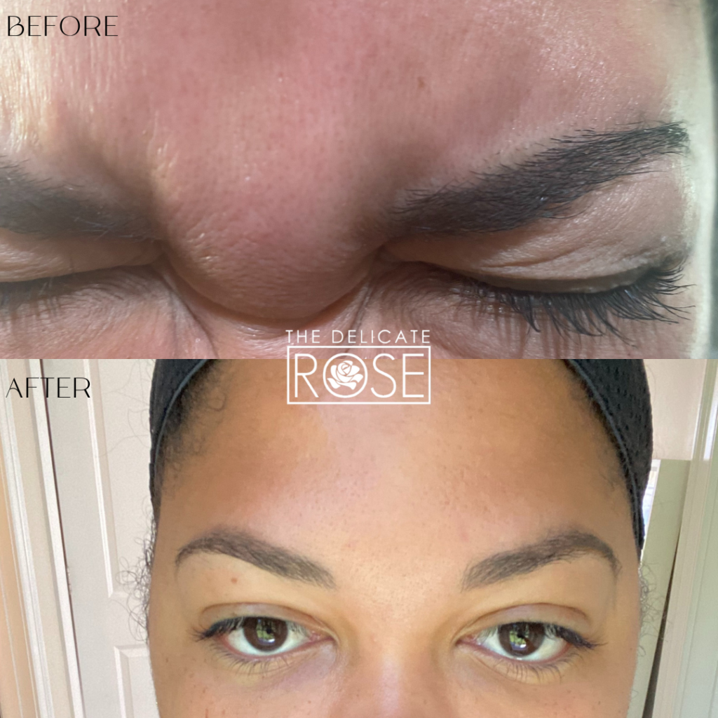 Before & After (Botox & Fillers) 11