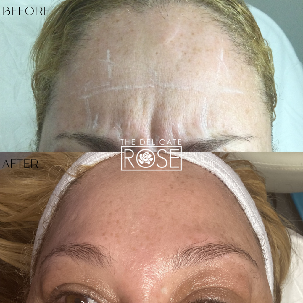 Before & After (Botox & Fillers) 4