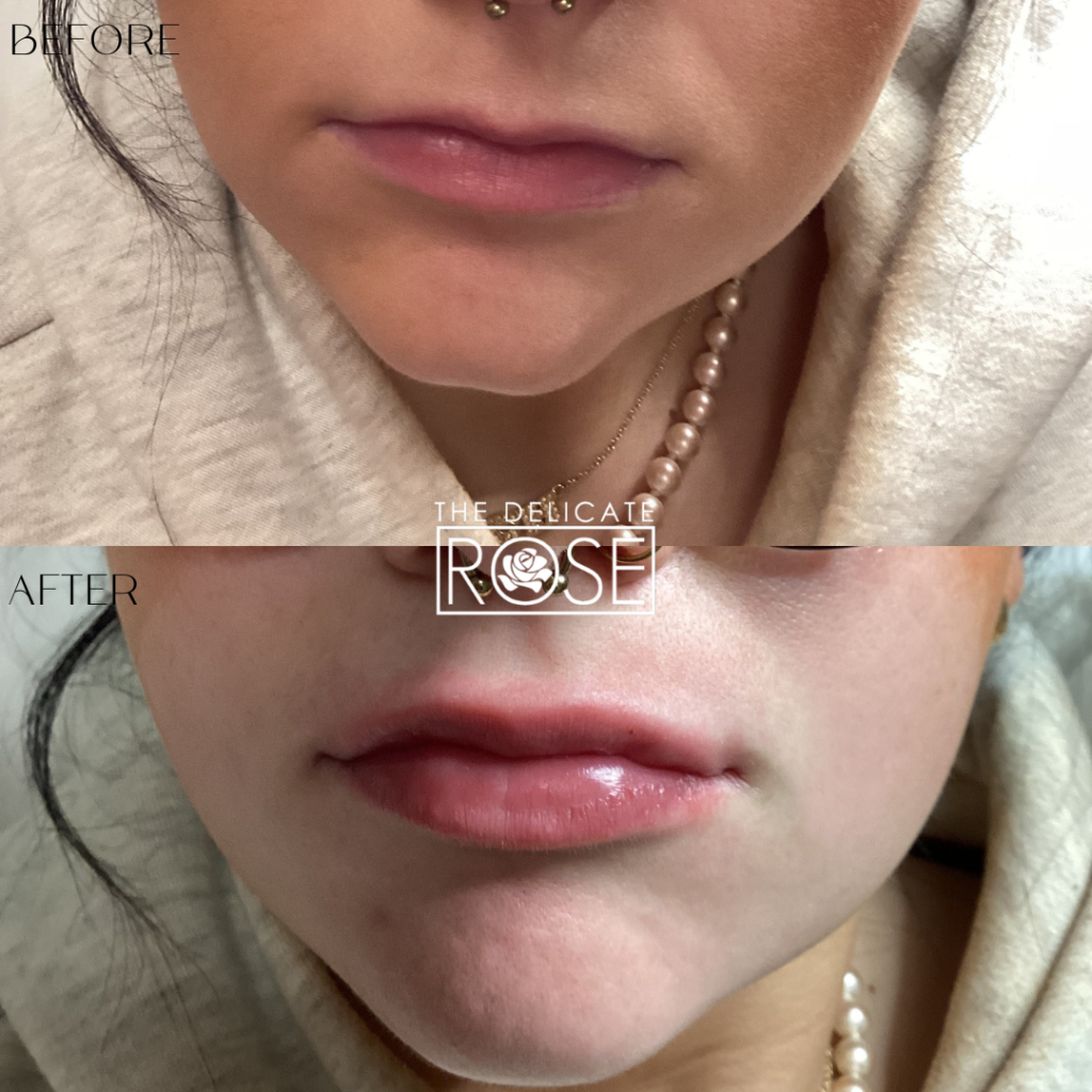 Before & After (Botox & Fillers) 5