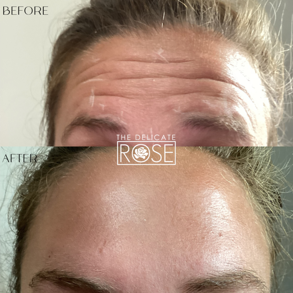 Before & After (Botox & Fillers) 7