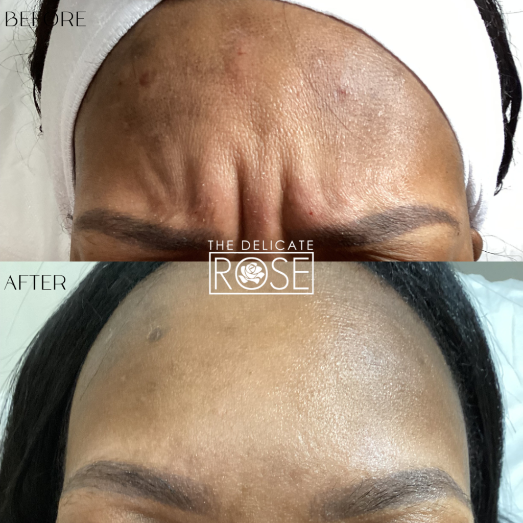 Before & After (Botox & Fillers) 8