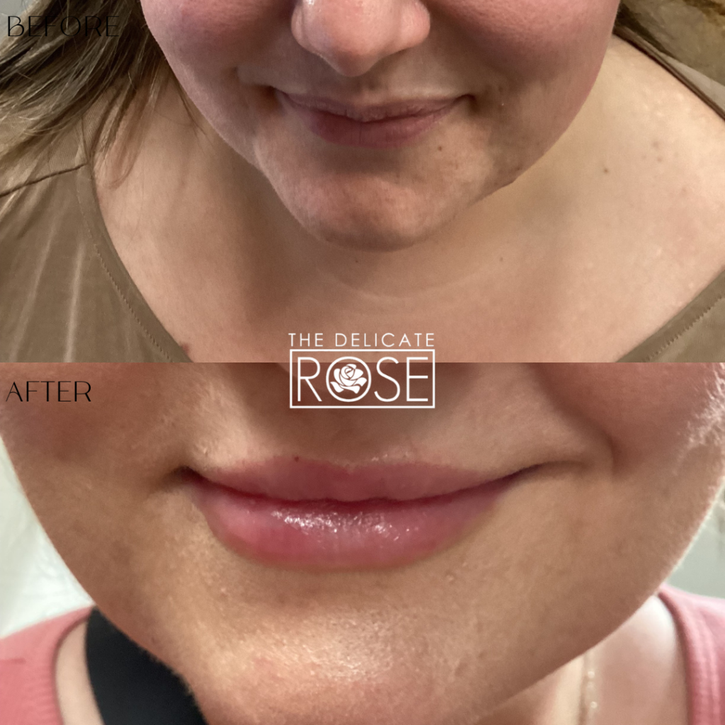 Before & After (Botox & Fillers) 9