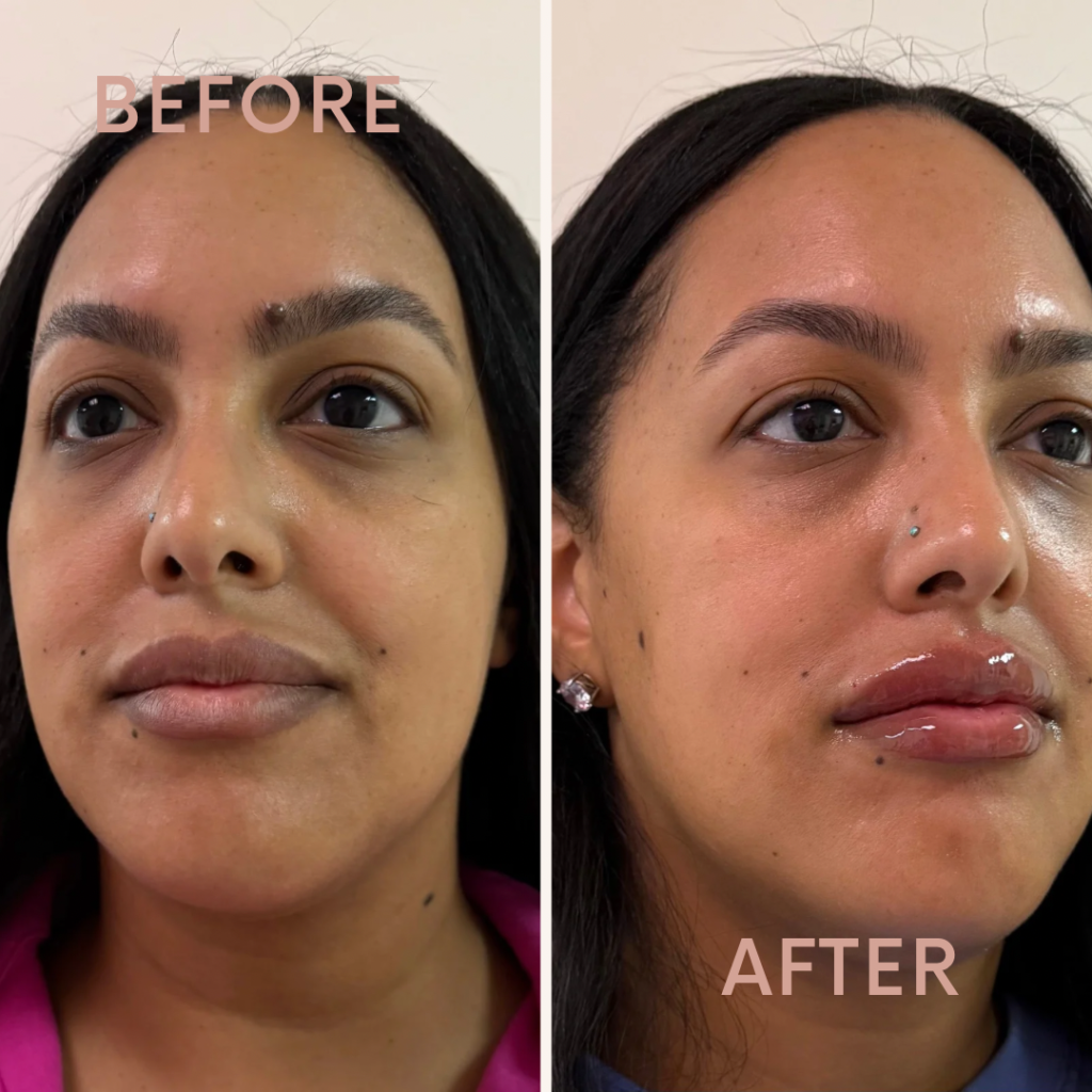 Before & After