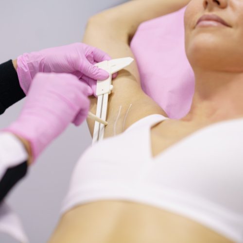 Doctor painting on the armpit of her patient, the area to be treated for hyperhidrosis